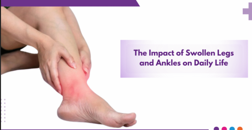 'पैरों की सूजन (Heart disease)
